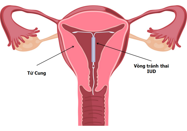 vong-tranh-thai-IUD