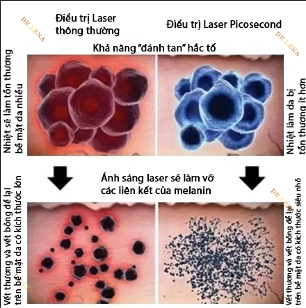 Điều trị nám da bằng laser