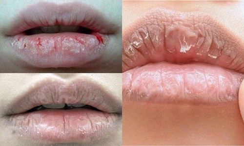 Môi bị thâm do sử dụng mỹ phẩm