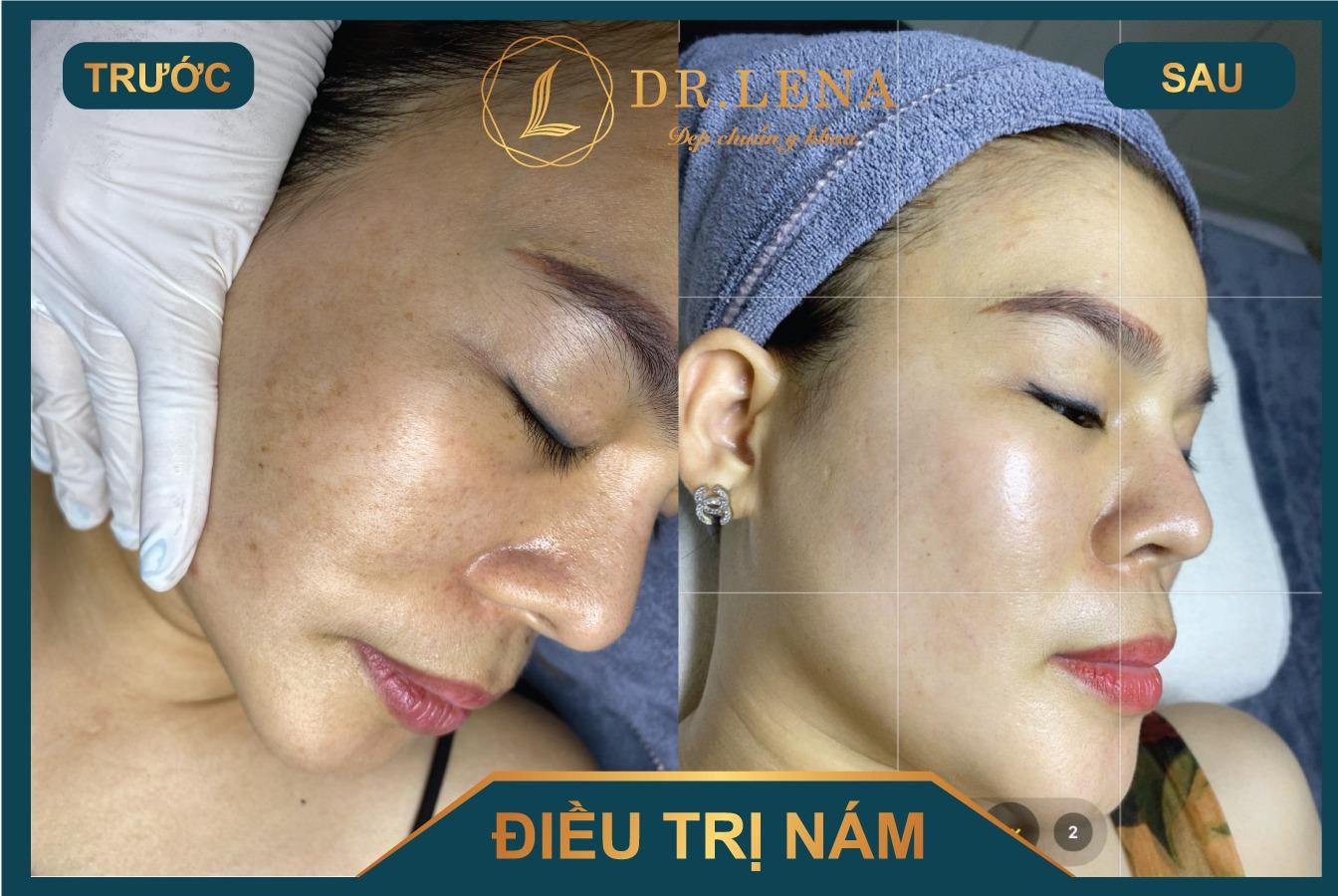 Kết quả khách hàng điều trị nám da bằng tia laser tại Viện thẩm mỹ Y khoa Dr.Lena