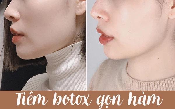 Trước và sau khi tiêm botox thon gọn hàm