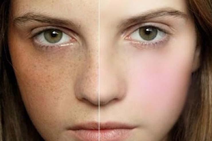 Trước và sau điều trị tàn nhang trên mặt