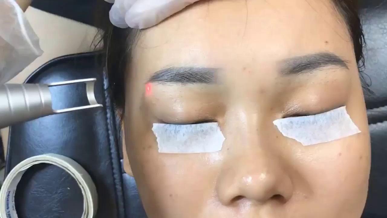 Xoá lông mày bằng laser an toàn