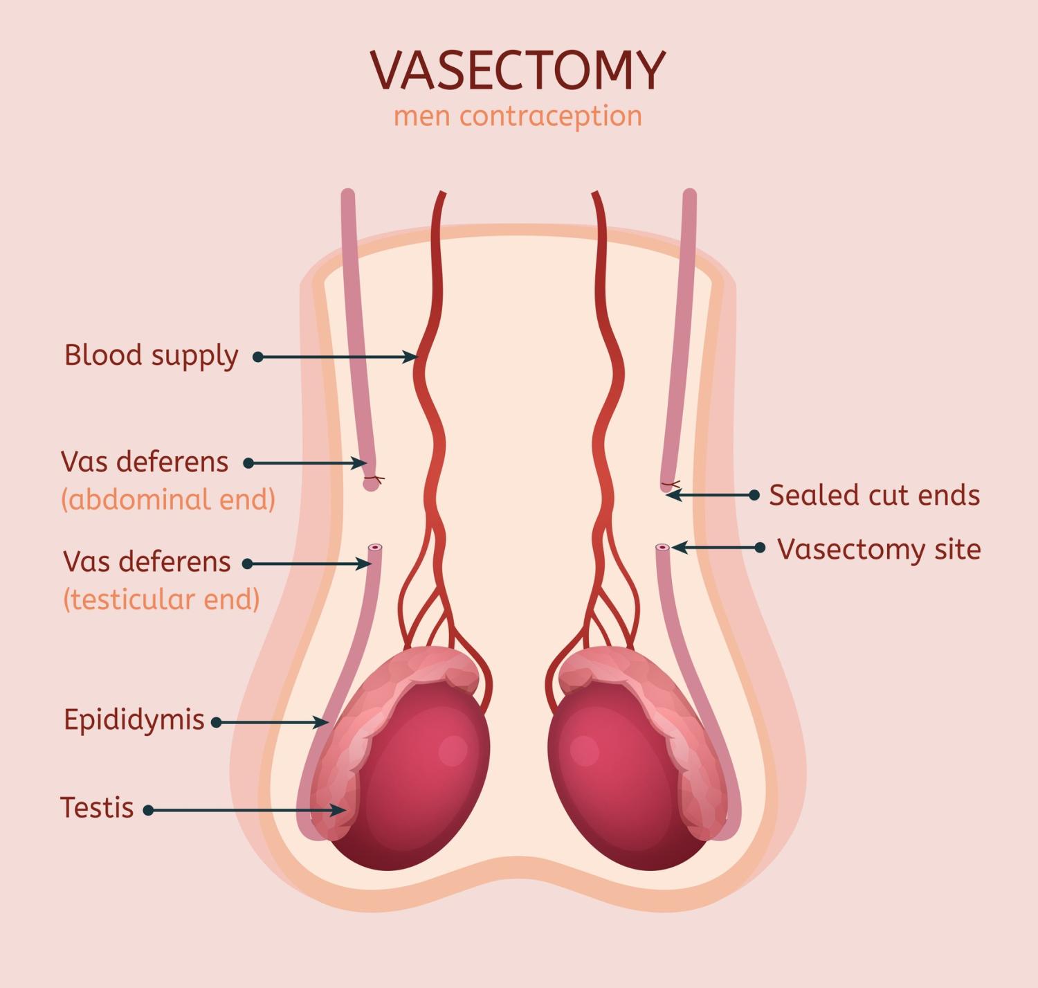 Nguồn ảnh: Vasectomy Reversal, University of Florida Health