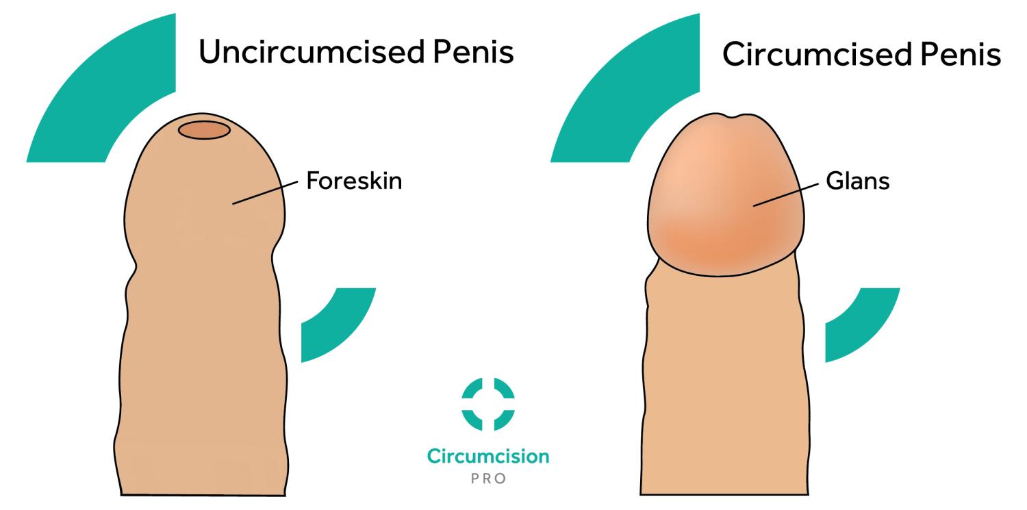 https://cdn.noron.vn/2022/04/10/circumcised-vs-uncircumcised-01-1649583766.jpg