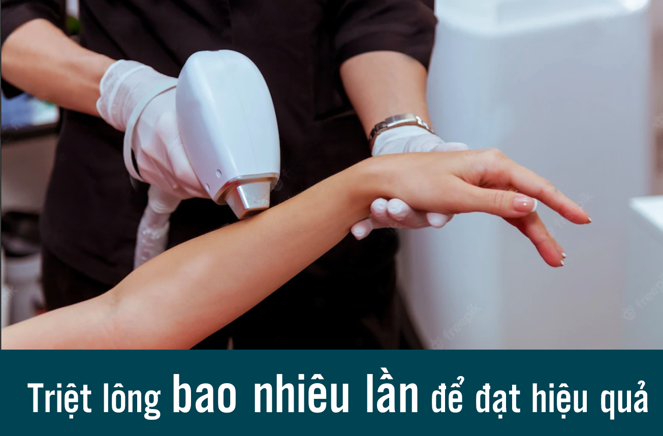 Triệt lông bao nhiêu lần để đạt hiệu quả như mong muốn?