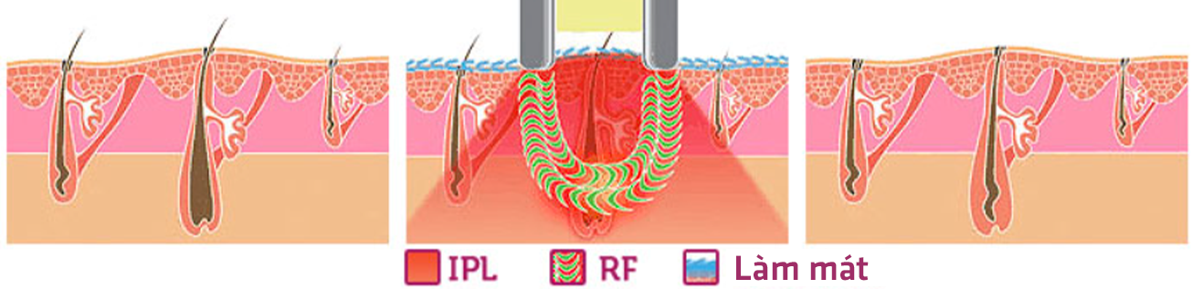 Cơ chế hoạt động của phương pháp triệt lông công nghệ Elight
