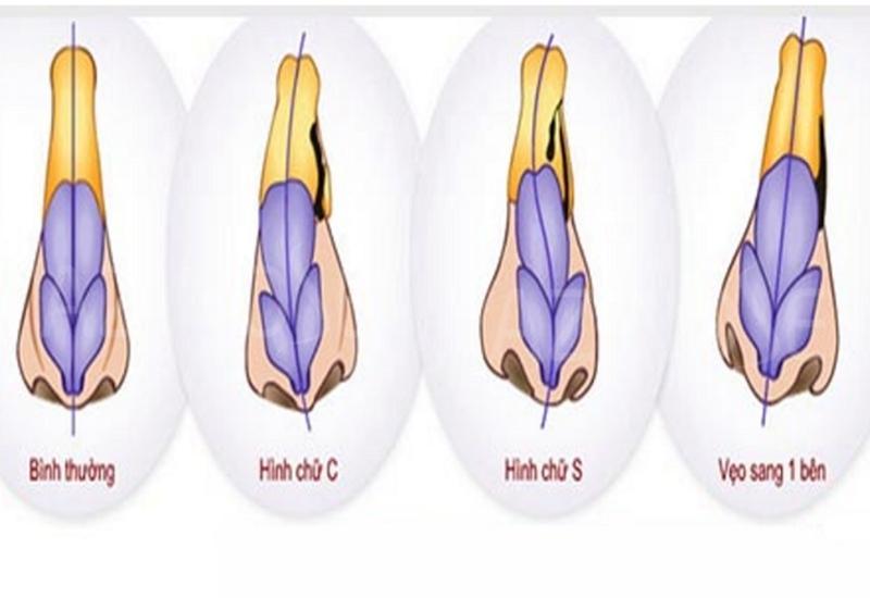 Các loại mũi lệch