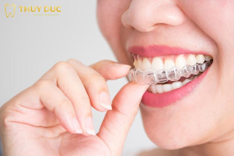 https://cdn.noron.vn/2023/01/04/uu-diem-noi-bat-nieng-rang-trong-suot-invisalign-1-1672838249.jpg