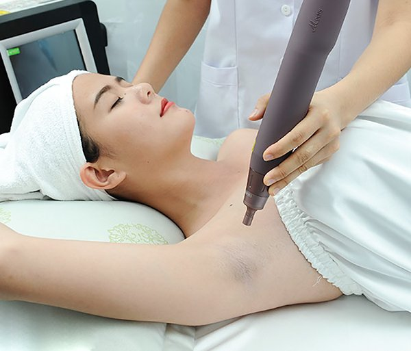 Trị thâm nách bằng laser