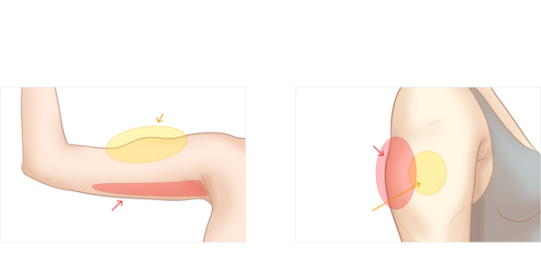 Tiêm botox thon gọn bắp tay 
